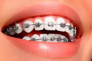 brackets-cuanto-cuestan