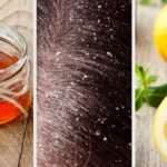 Cómo eliminar la caspa con remedios naturales