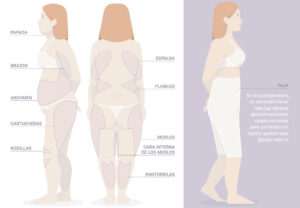 liposuccion-cuanto-cuesta