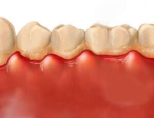 como-la-pasta-dental-puede-ayudar-a-tratar-la-gingivitis