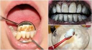 elimina-el-sarro-con-la-mejor-pasta-de-dientes